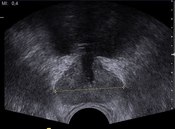 gezonde prostaat op echografie na inname van Predstonorm