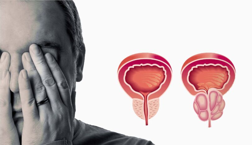 Chronische prostatitis