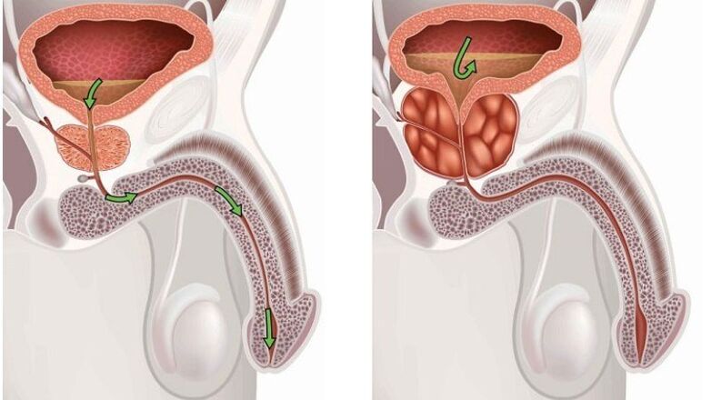gezonde en ontstoken prostaatklier met prostatitis