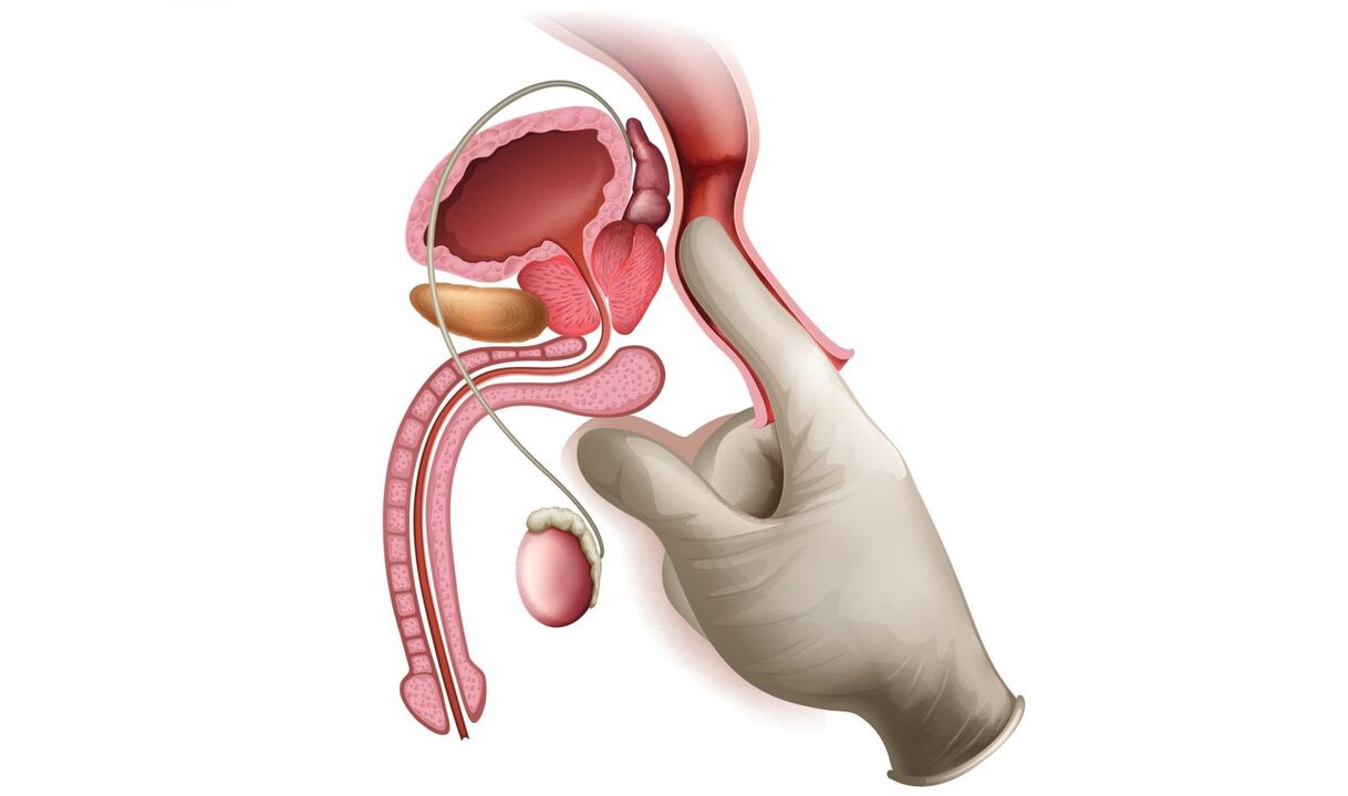 prostaatmassage voor prostatitis