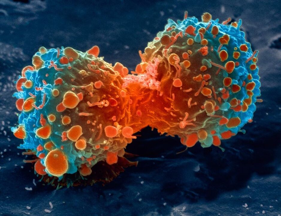 tumorcel als complicatie van prostatitis