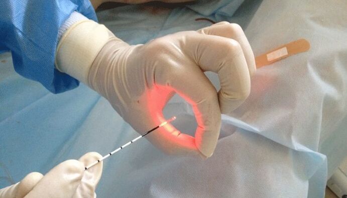 laserbehandeling voor prostatitis